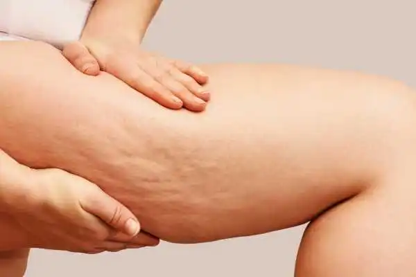 Image of woman showing leg with cellulite Essex