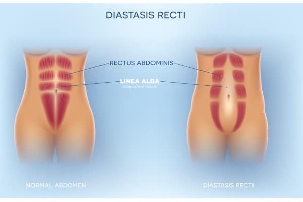 What Non-Surgical Options Are Available for Diastasis Recti Essex?