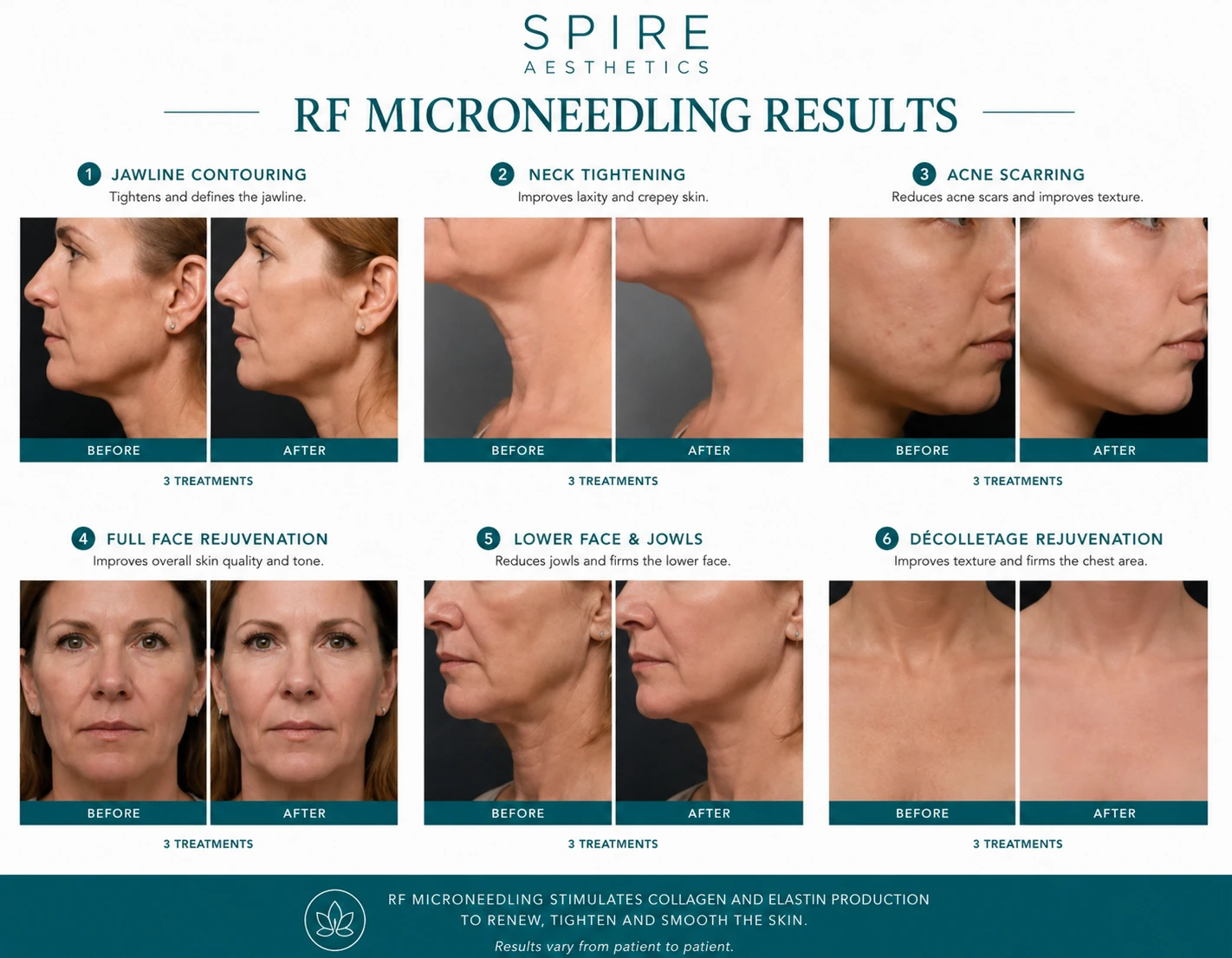RF Microneedling Skin tightening Essex results