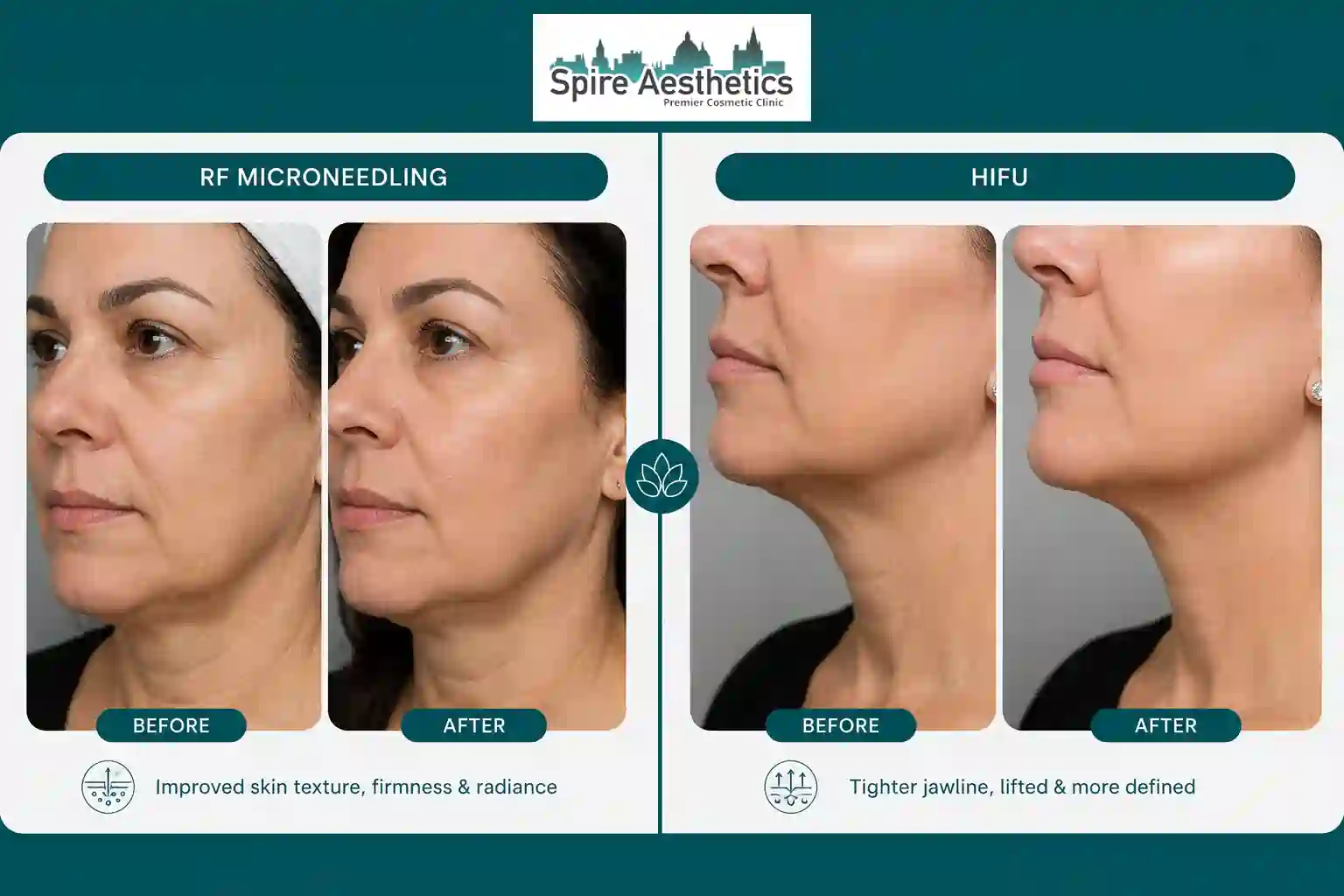 Can RF Microneedling and HIFU Be Combined Essex?
