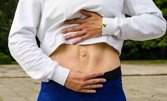 When Could Diastasis Recti Be the Missing Piece of the Puzzle Essex?