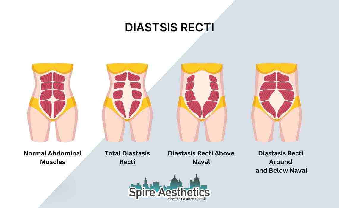 Is Non-Surgical Diastasis Recti Treatment Right for You? Common Concerns Answered Essex